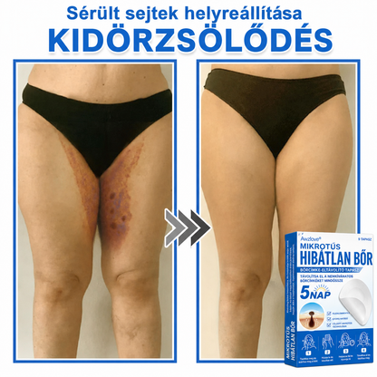Awzlove® 2 az 1-ben mikrotűs és hidrokolloid tapasz | Kiemelkedő anyajegyek, pattanások, lapos szemölcsök és bőrkinövések eltávolítója | Javítja a ráncokat, hegeket és bőrhibákat | Láthatatlan csillag alakú pattanástapaszok arcra és testre | 🎁🎁8