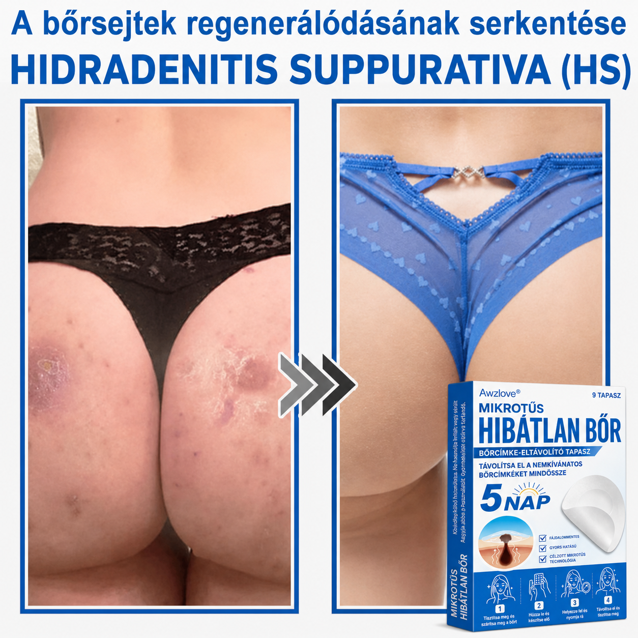 Awzlove® 2 az 1-ben mikrotűs és hidrokolloid tapasz | Kiemelkedő anyajegyek, pattanások, lapos szemölcsök és bőrkinövések eltávolítója | Javítja a ráncokat, hegeket és bőrhibákat | Láthatatlan csillag alakú pattanástapaszok arcra és testre | 🎁🎁8