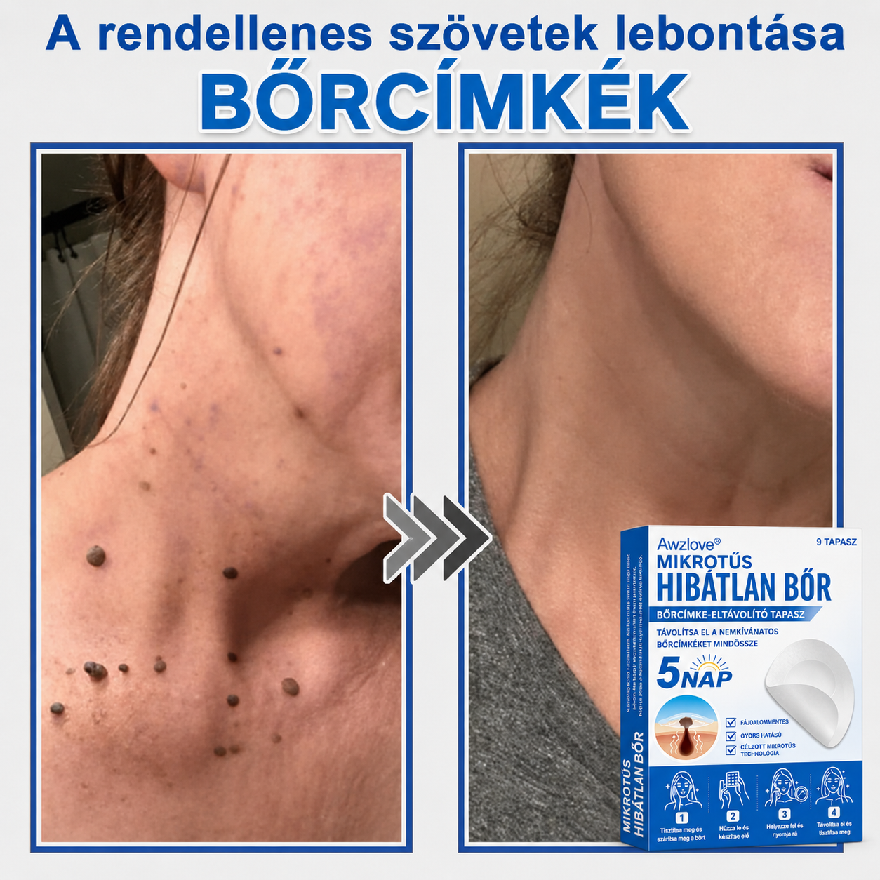 Awzlove® 2 az 1-ben mikrotűs és hidrokolloid tapasz | Kiemelkedő anyajegyek, pattanások, lapos szemölcsök és bőrkinövések eltávolítója | Javítja a ráncokat, hegeket és bőrhibákat | Láthatatlan csillag alakú pattanástapaszok arcra és testre | 🎁🎁8