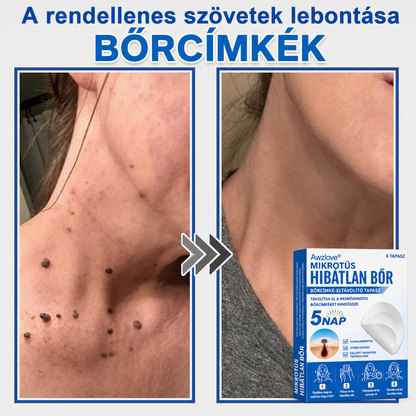 Awzlove® 2 az 1-ben mikrotűs és hidrokolloid tapasz | Kiemelkedő anyajegyek, pattanások, lapos szemölcsök és bőrkinövések eltávolítója | Javítja a ráncokat, hegeket és bőrhibákat | Láthatatlan csillag alakú pattanástapaszok arcra és testre | 🎁🎁8