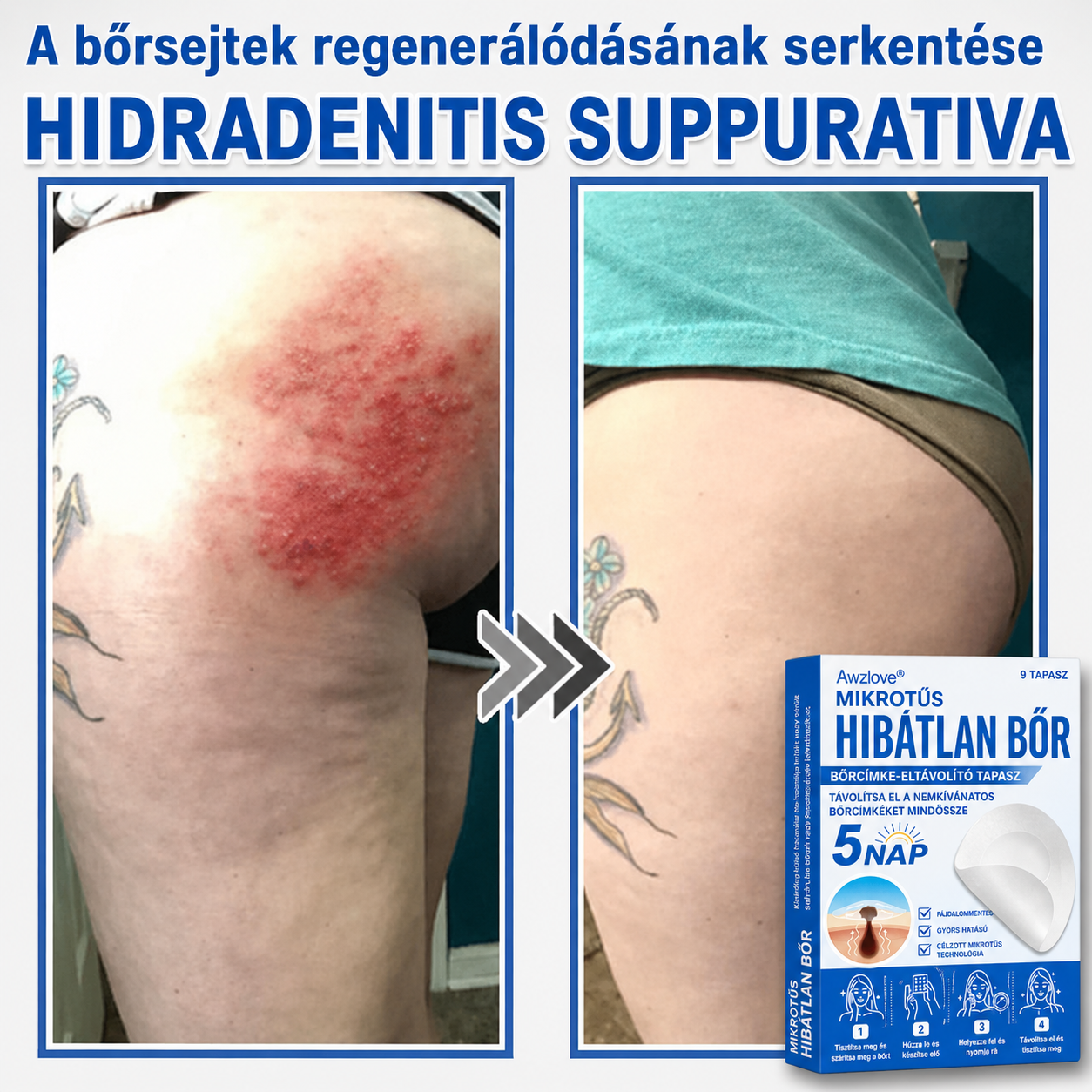 Awzlove® 2 az 1-ben mikrotűs és hidrokolloid tapasz | Kiemelkedő anyajegyek, pattanások, lapos szemölcsök és bőrkinövések eltávolítója | Javítja a ráncokat, hegeket és bőrhibákat | Láthatatlan csillag alakú pattanástapaszok arcra és testre | 🎁🎁8