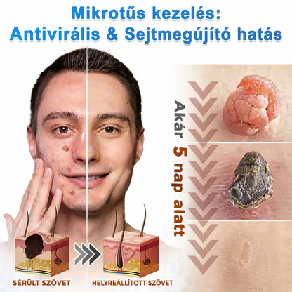 Awzlove® 2 az 1-ben mikrotűs és hidrokolloid tapasz | Kiemelkedő anyajegyek, pattanások, lapos szemölcsök és bőrkinövések eltávolítója | Javítja a ráncokat, hegeket és bőrhibákat | Láthatatlan csillag alakú pattanástapaszok arcra és testre | 🎁🎁8