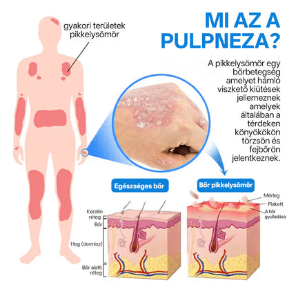 ⭐Healrize® 🎉Magnézium Gyógynövényes Pszoriázis Spray-🌻