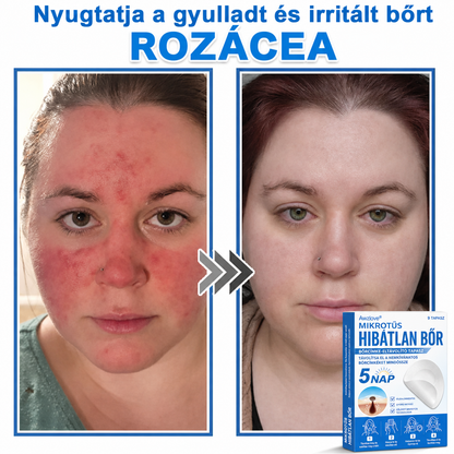 Awzlove® 2 az 1-ben mikrotűs és hidrokolloid tapasz | Kiemelkedő anyajegyek, pattanások, lapos szemölcsök és bőrkinövések eltávolítója | Javítja a ráncokat, hegeket és bőrhibákat | Láthatatlan csillag alakú pattanástapaszok arcra és testre | 🎁🎁8