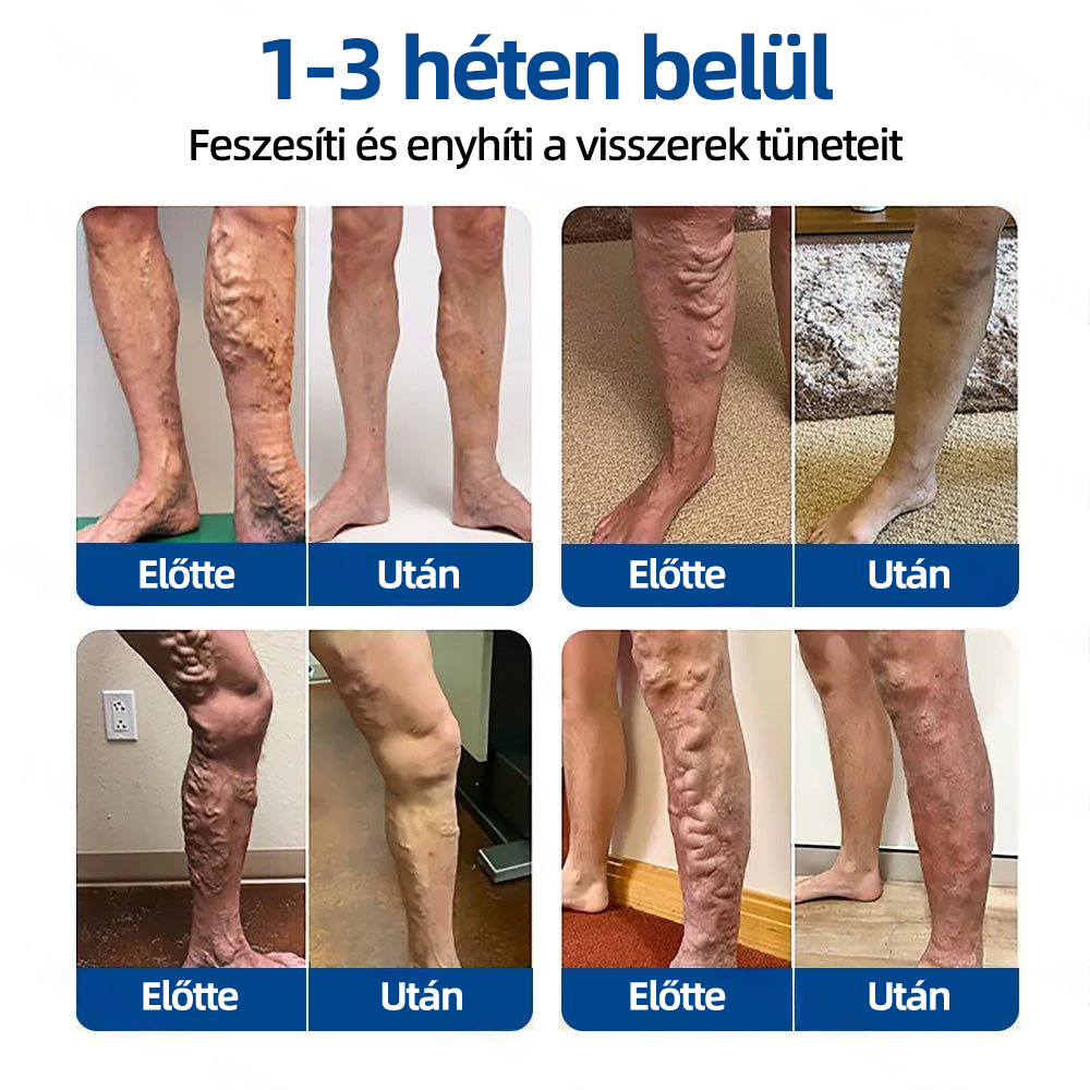 🇭🇺👨‍⚕️👍✅ Healrize® VeinTarget mikrotűs tapasz 🛒Azonnali enyhülés, hosszú távú eredmények🛒