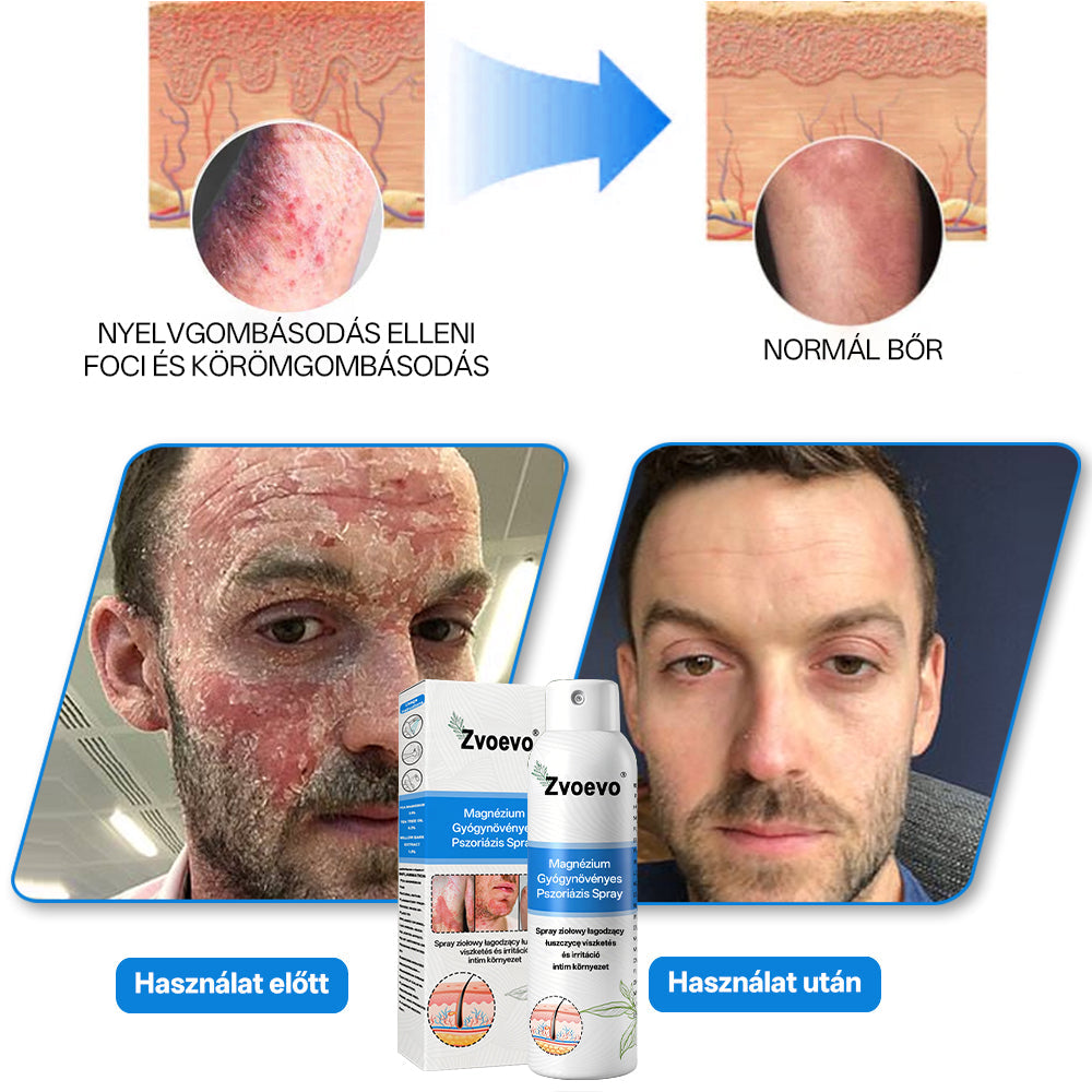 ⭐Healrize® 🎉Magnézium Gyógynövényes Pszoriázis Spray-🌻