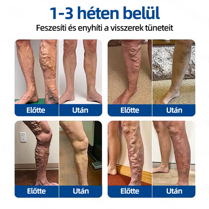 🇭🇺👨‍⚕️👍✅ Healrize® VeinTarget mikrotűs tapasz ⚡Azonnali enyhülés, hosszú távú eredmények