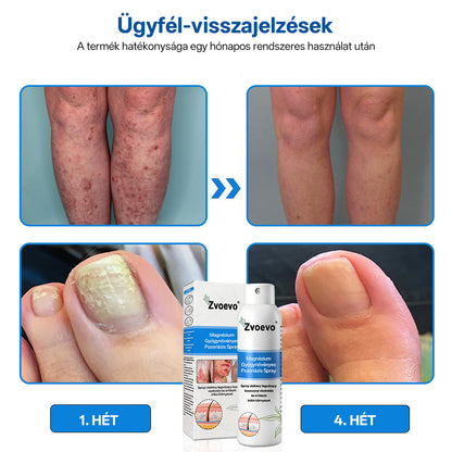 ⭐Healrize® 🎉Magnézium Gyógynövényes Pszoriázis Spray-🌻