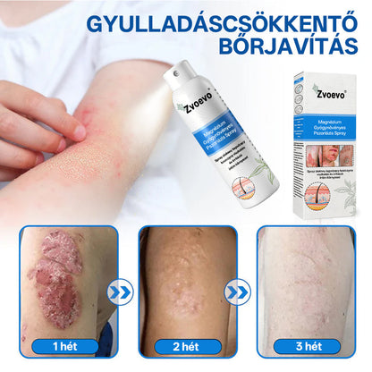 ⭐Healrize® 🎉Magnézium Gyógynövényes Pszoriázis Spray-🌻