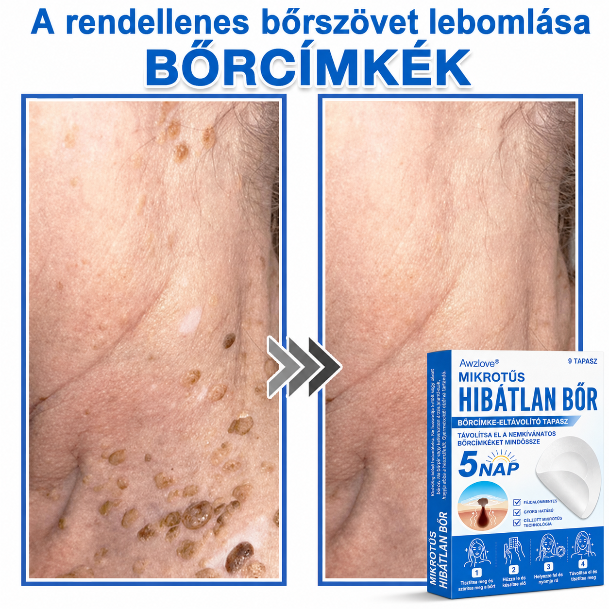 Awzlove® 2 az 1-ben mikrotűs és hidrokolloid tapasz | Kiemelkedő anyajegyek, pattanások, lapos szemölcsök és bőrkinövések eltávolítója | Javítja a ráncokat, hegeket és bőrhibákat | Láthatatlan csillag alakú pattanástapaszok arcra és testre | 🎁🎁8